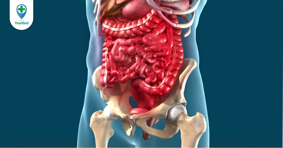 Nguyên nhân dẫn đến IBD?
