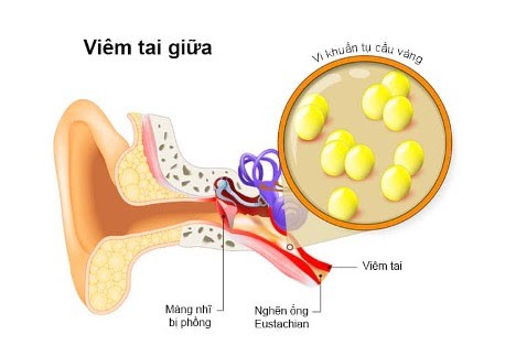 Cơ chế bệnh sinh viêm tai giữa cấp