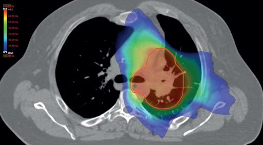 Khối u phổi đang được vẽ trường chiếu xạ trên CT scan
