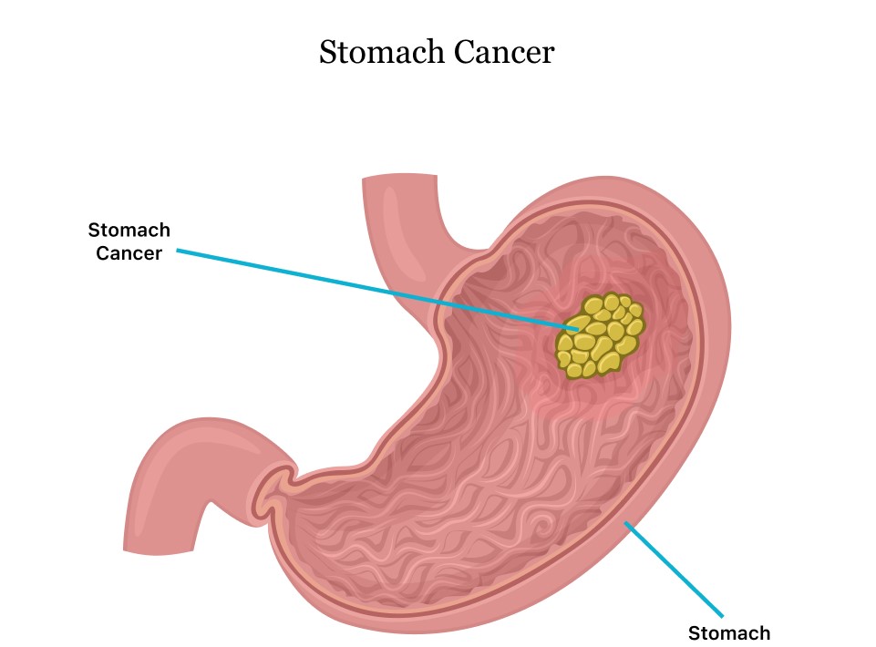 Ung thư dạ dày là loại ung thư của đường tiêu hóa