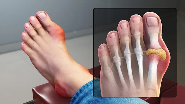 Triệu chứng đau dữ dội ở ngón cái là đặc trưng của bệnh gout