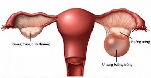 Cấu tạo của buồng trứng khi được chẩn đoán u nang buồng trứng