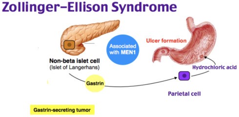 Hội chứng Zollinger-Ellison do u tăng tiết Gastrin tại tụy, kích thích tế bào thành ở dạ dày tăng tiết acid tạo thành những ổ loét