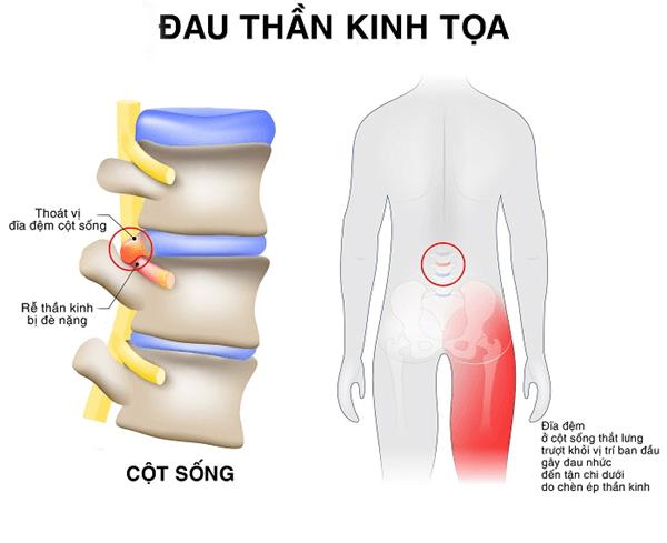 Đau thần kinh tọa