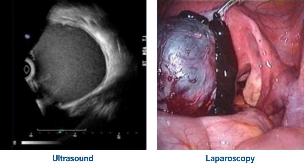 Hình ảnh nang lạc nội mạc tử cung trên siêu âm (bên trái) và kết quả mổ thực tế (bên phải)
