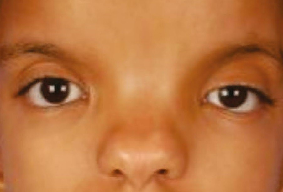 Một trong những biểu hiện có thể gặp ở người nam mắc phải hội chứng Jacobs là khoảng cách xa bất thường giữa 2 mắt