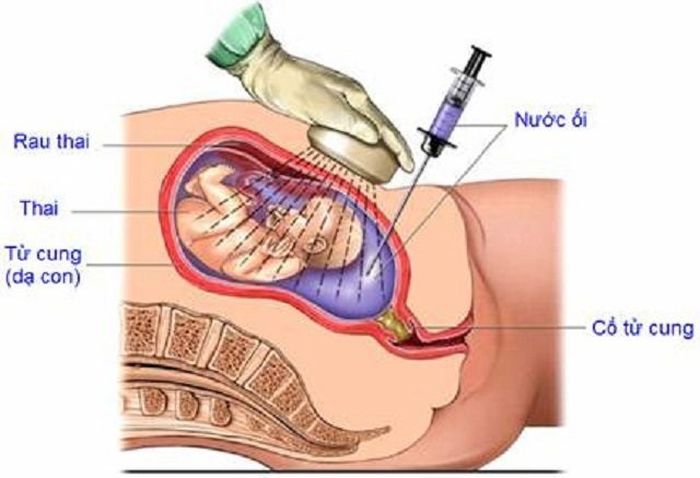 CVS là một xét nghiệm xâm lấn được thực hiện vào thời gian đầu của thai kỳ để tầm soát các rối loạn về di truyền