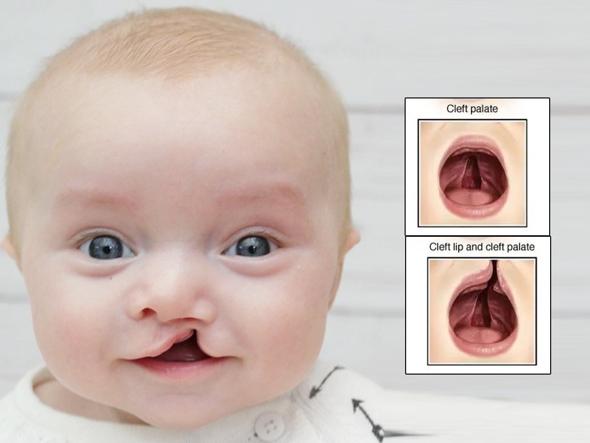 Hội chứng Patau có thể gây nên nhiều bất thường trên cấu trúc mặt của trẻ như sứt môi, hở hàm ếch