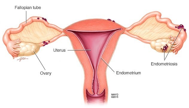 Mô nội mạc tử cung (những nốt đỏ) nằm sai vị trí, thay vì trong buồng tử cung thì lại nằm ở buồng trứng, vòi trứng