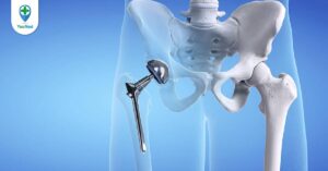 Phẫu thuật thay khớp háng và những lưu ý bạn cần