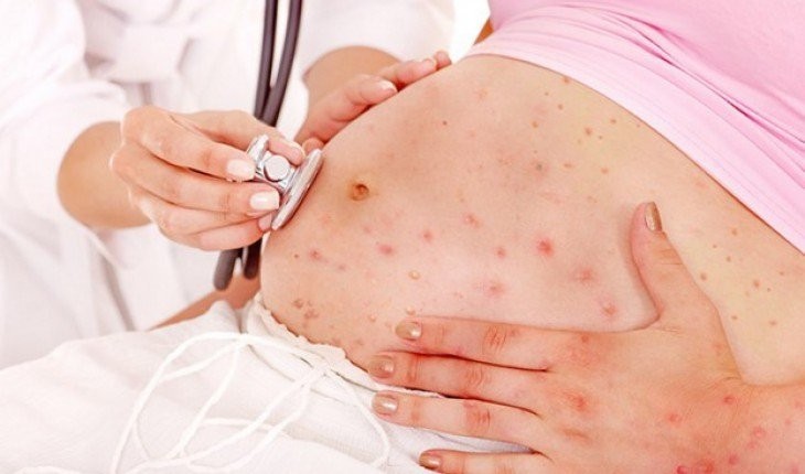 Phụ nữ mang thai mắc bệnh thủy đậu có nguy cơ xuất hiện các biến chứng nghiêm trọng, chủ yếu là viêm phổi