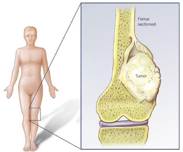 Vị trí thường gặp của sarcom xương (gần gối, xa khuỷu)