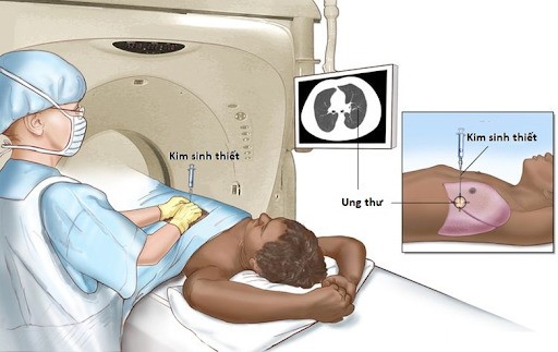 Kỹ thuật sinh thiết xuyên thành ngực dưới hướng dẫn của CT scan ngực