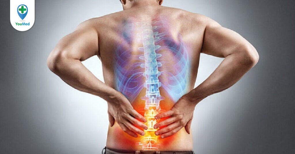 Top 8 bài tập hỗ trợ điều trị cho người thoát vị đĩa đệm hiệu quả, giảm đau lưng
