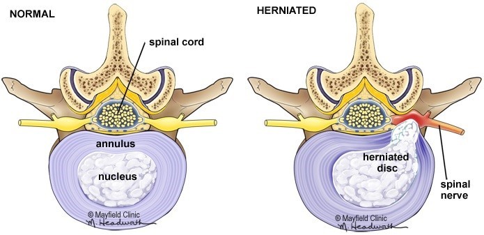 Đĩa đệm bình thường (normal) và đĩa đệm thoát vị (herniated). Nhân nhầy thoát ra qua một vết rách vòng xơ và chèn vào rễ thần kinh
