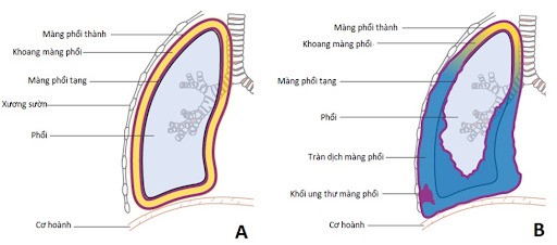 (A) Màng phổi bình thường - (B) Ung thư màng phổi gây tràn dịch màng phổi