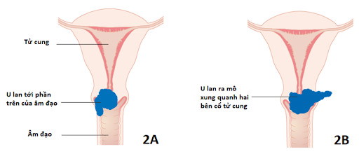 Ung thư cổ tử cung giai đoạn 2 (2A và 2B)