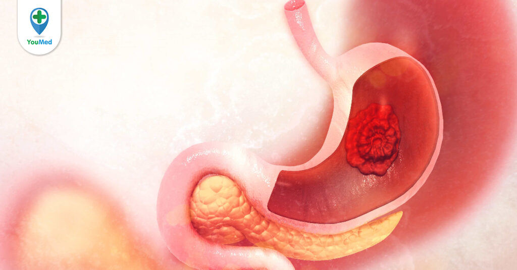 Tổng hợp các phương pháp tầm soát ung thư dạ dày hiện nay