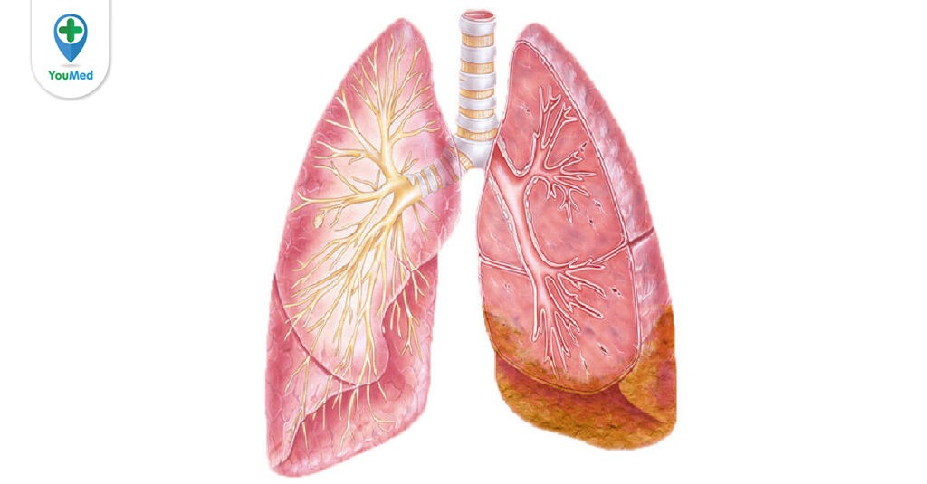 Ung thư màng phổi: dấu hiệu, chẩn đoán và cách điều trị