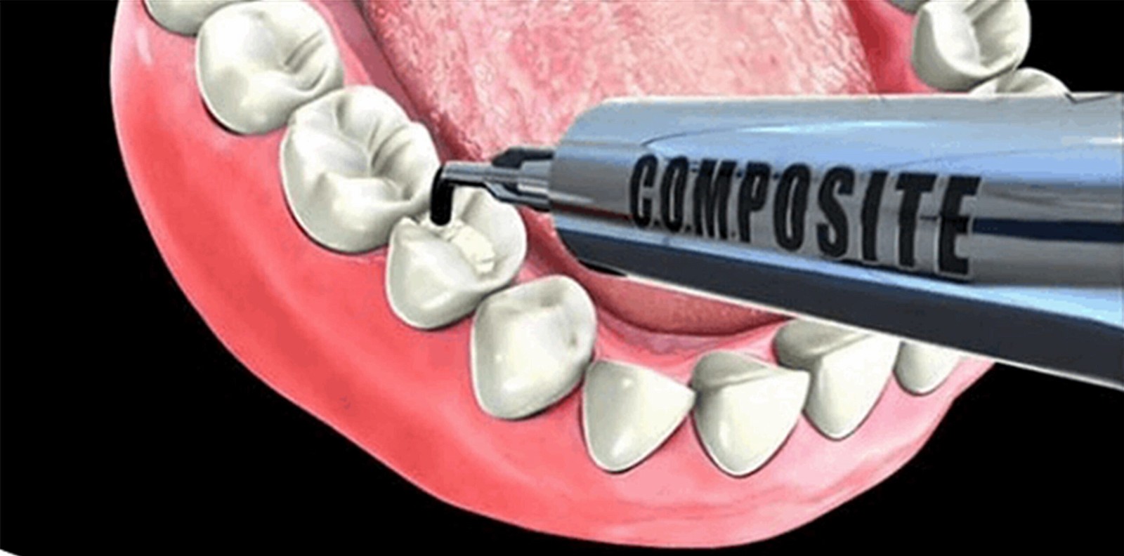 Composite trám răng là một trong những loại vật liệu trám răng hiện nay
