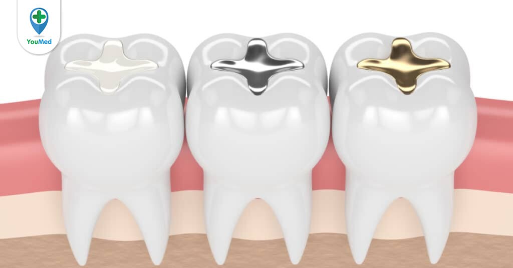 Các vật liệu trám răng được sử dụng hiện nay