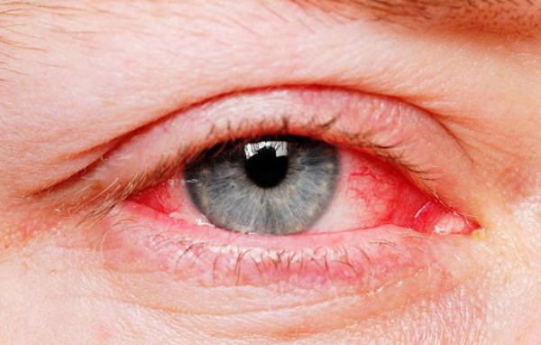  Viêm kết mạc dị ứng biểu hiện bởi tình trạng mắt bị đỏ, ngứa, cảm giác cộm