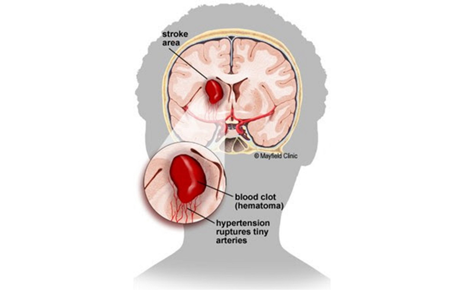 Xuất huyết não thường do vỡ các động mạch nhỏ trong mô não (trái). Khi máu đông lại, cục máu đông hình thành gây tăng áp lực đè ép lên nhu mô não