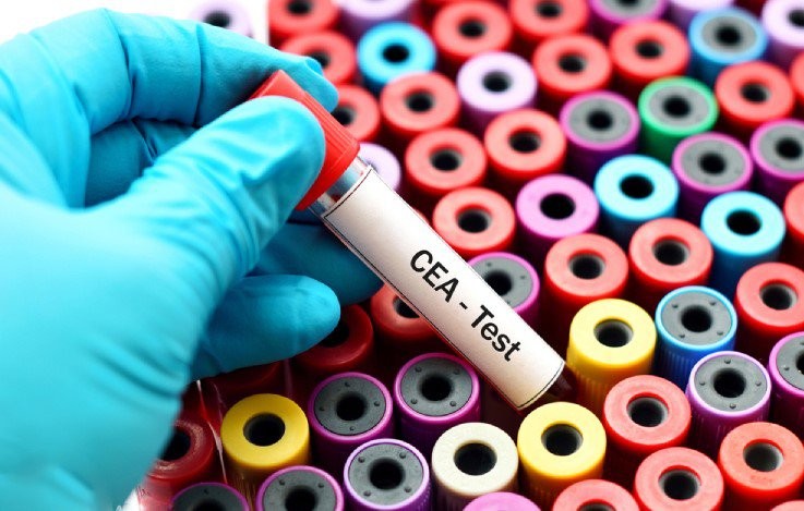 Xét nghiệm CEA là một trong các xét nghiệm tầm soát ung thư đường tiêu hóa.