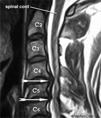 MRI (chụp bên) cho thoát vị đĩa đệm C4 C5. Cũng được chỉ ra là các dấu hiệu của hẹp cột sống, một sự hẹp của ống sống làm cho cột sống xuất hiện nếp nhăn