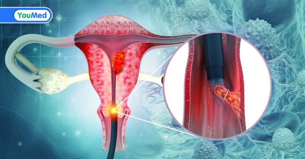 Ung thư cổ tử cung giai đoạn cuối: Dấu hiệu, mức độ nguy hiểm và điều trị