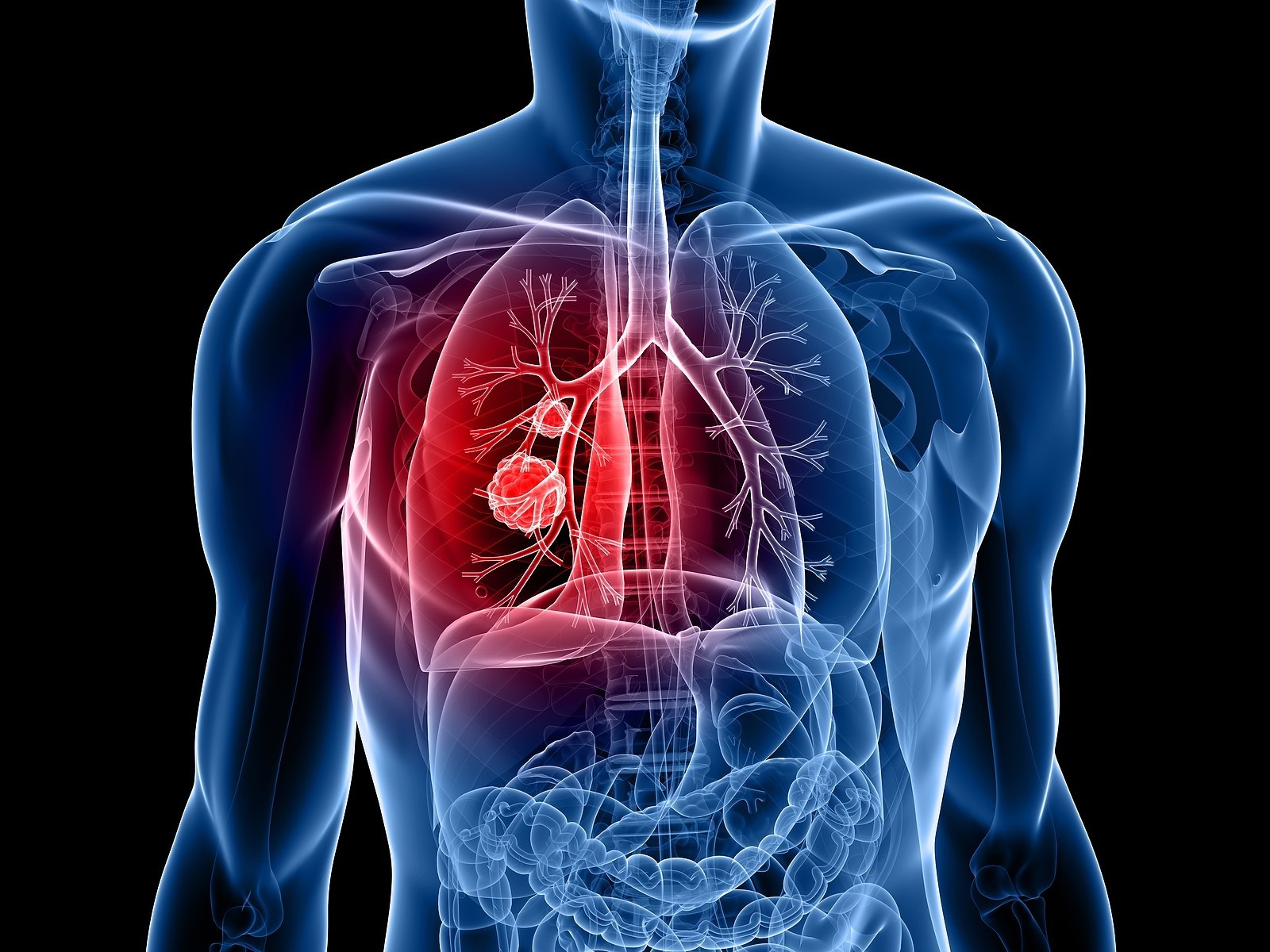 Xét nghiệm Cyfra 21-1 có thể giúp chẩn đoán ung thư phổi