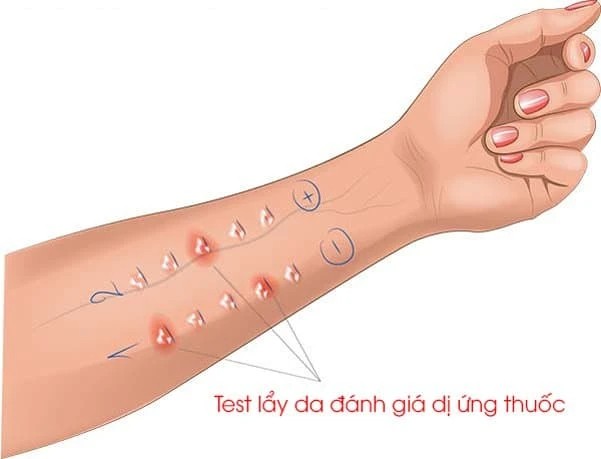 Test lẩy da là một trong những phương pháp xét nghiệm dị ứng