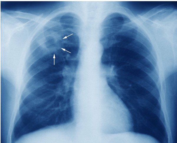 Hình ảnh X - quang bệnh nhân bị lao hạch
