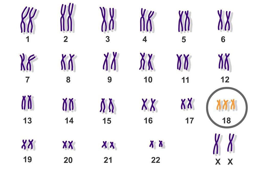 Hội chứng Edwards với sự đột biến ở nhiễm sắc thể 18