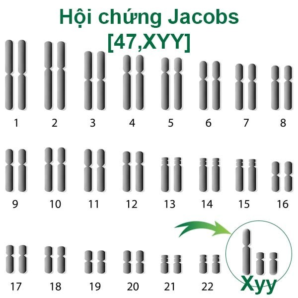 Hội chứng Jacobs có thể được phát hiện bằng xét nghiệm nhiễm sắc thể