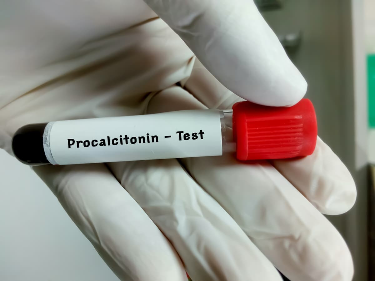 Xét nghiệm Procalcitonin