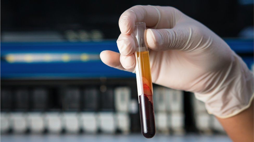 Xét nghiệm máu có thể phát hiện chất chỉ điểm ung thư chứ không chẩn đoán chính xác bệnh ung thư