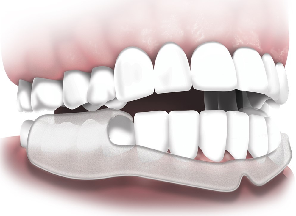 Sử dụng máng chống nghiến răng là một trong những cách giúp ngăn chặn các tác hại của việc nghiến răng