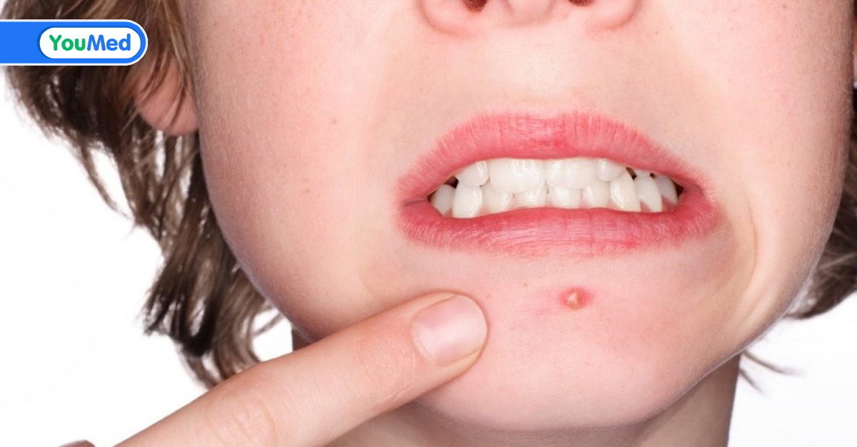 Mụn ở trán: Yếu tố nguy cơ và cách điều trị hiệu quả