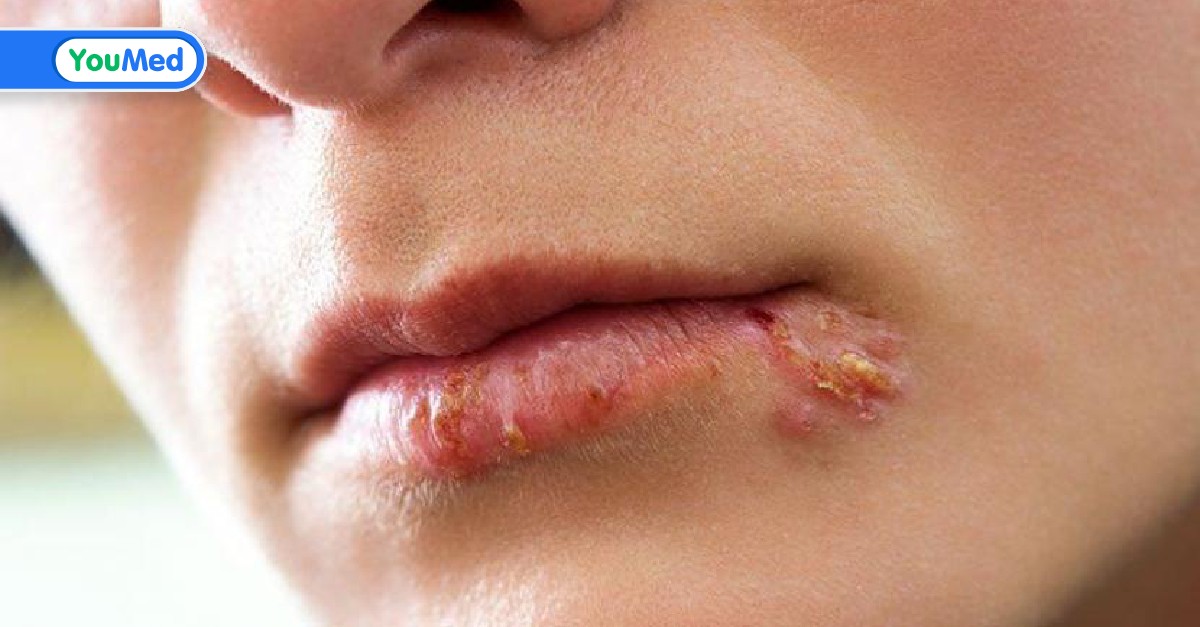 Thực đơn nào phù hợp cho người bị virus herpes ở môi?
