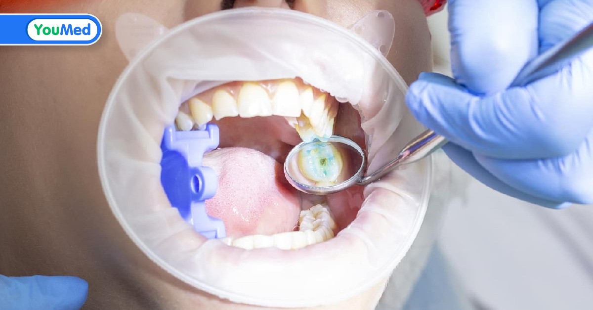 Quy trình điều trị răng khôn bị sâu nặng như thế nào?
