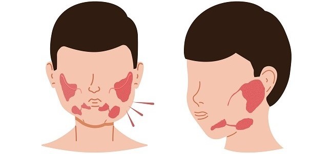 Khi mắc quai bị, bệnh nhân thường bị sưng một hoặc cả hai tuyến nước bọt ở hai bên mặt
