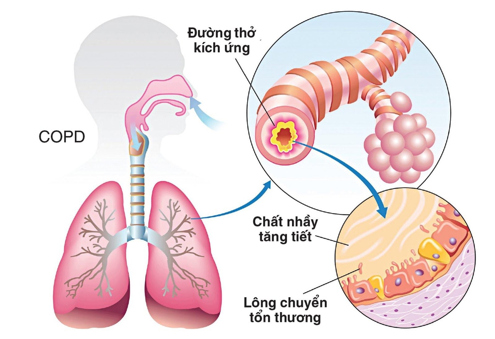 Bệnh phổi tắc nghẽn mạn tính (COPD) là một trong những nguyên nhân có thể gây suy hô hấp