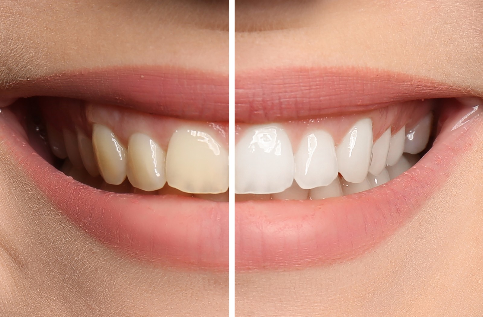 Tẩy trắng giúp cải thiện hàm răng ố vàng mang lại sự tự tin cho nhiều người