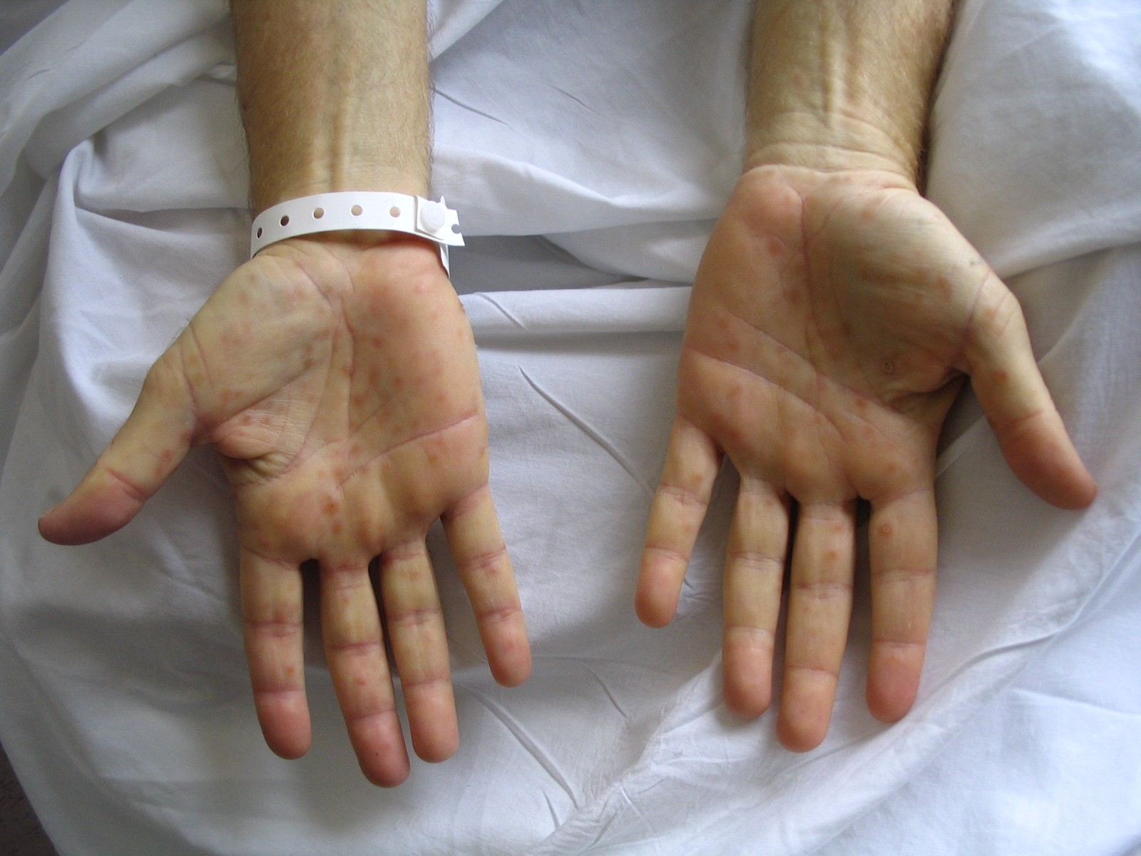 Triệu chứng phát ban ở lòng bàn tay