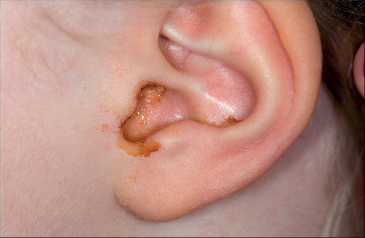 Brodicef được chỉ định trị viêm tai giữa