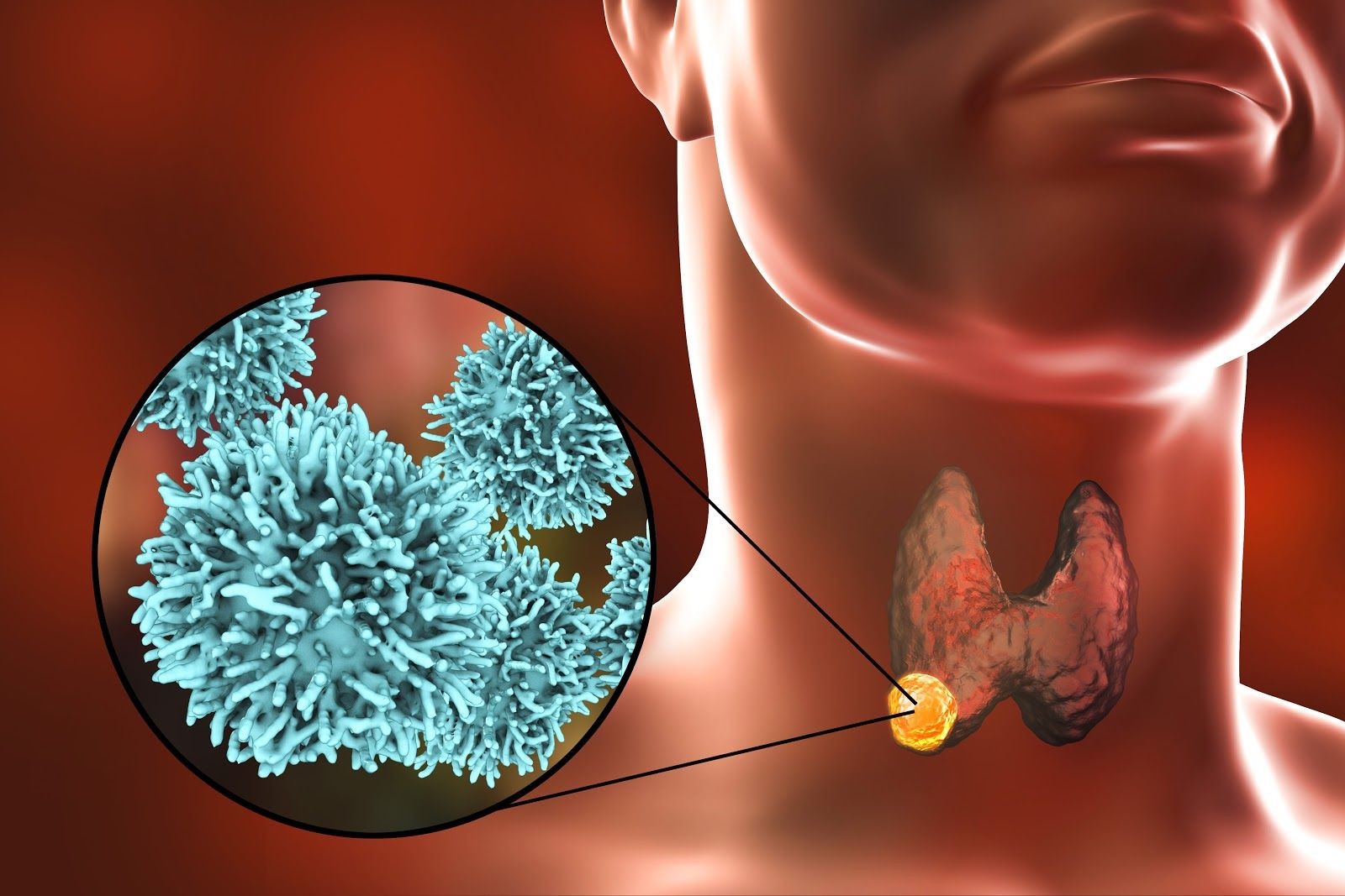 Ung thư tuyến giáp xảy ra khi các tế bào tuyến giáp tăng sinh vượt kiểm soát tạo thành khối u