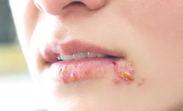 Vết loét ở miệng và môi người mắc bệnh giang mai