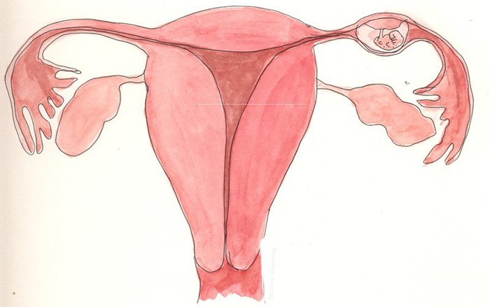 Hiện tượng tắc vòi trứng có thể khiến phụ nữ mang thai ngoài tử cung