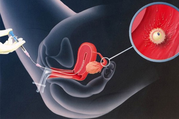 Phôi thai sẽ được đưa vào tử cung sau 3 - 5 ngày sau khi thụ tinh